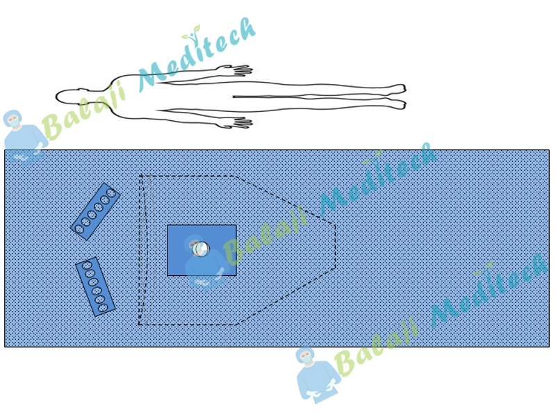 Knee Arthroscopy Drape